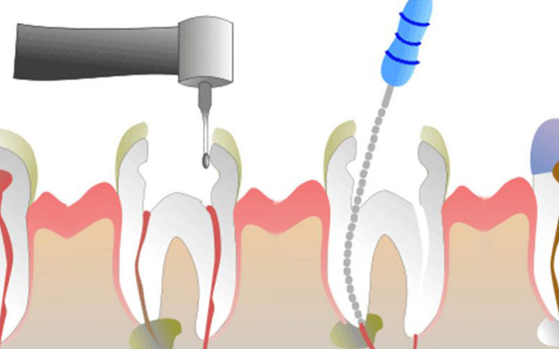 endodontia-funbeo